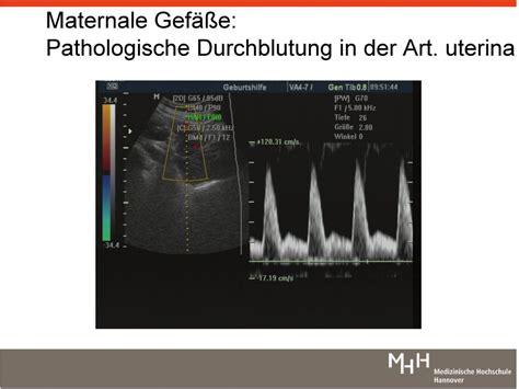 Doppler maternale Gefäße